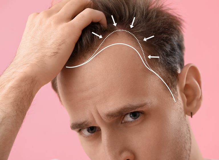 Upset,Young,Man,With,Hair,Loss,Problem,On,Pink,Background,