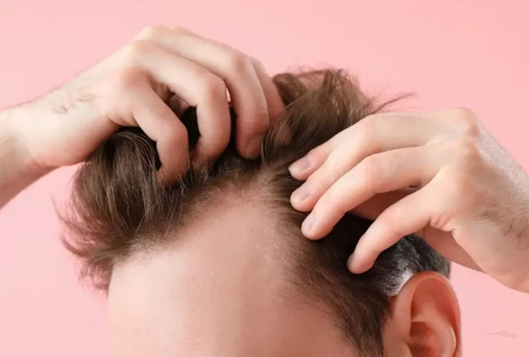 כמה זמן מחזיקה השתלת שיער