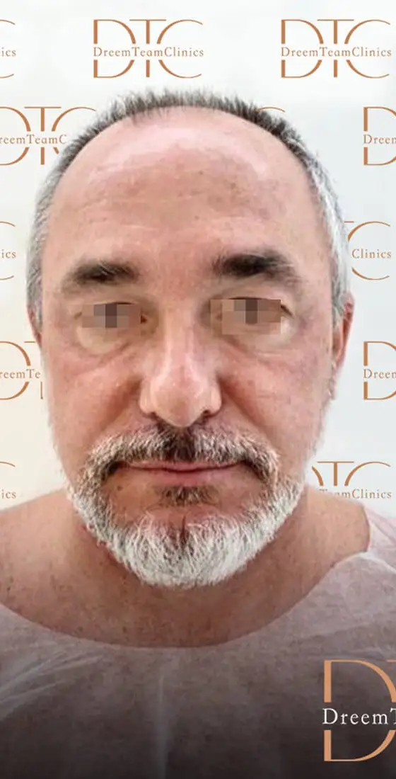 השתלות שיער לגברים