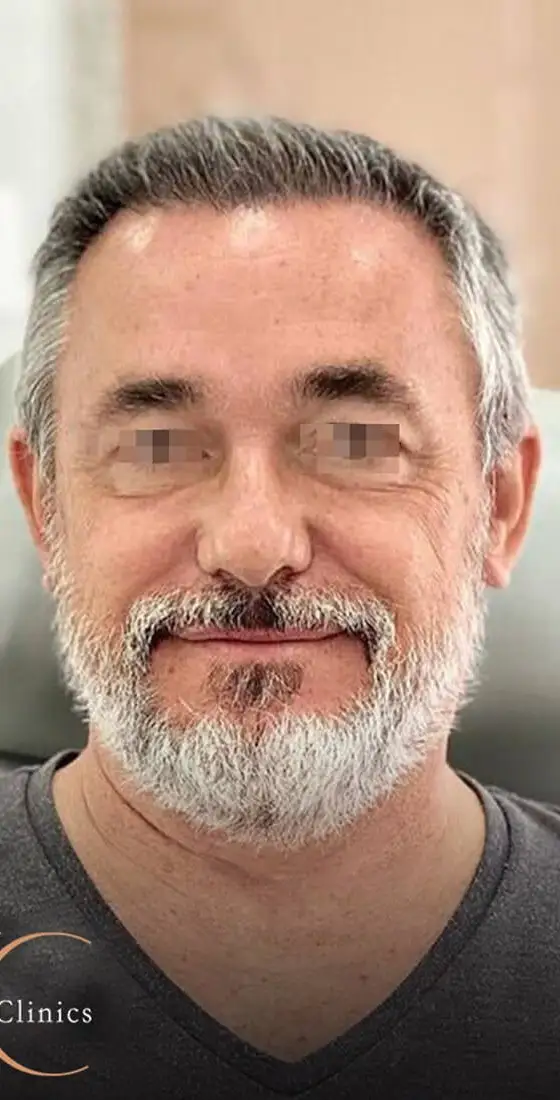 השתלות שיער לגברים