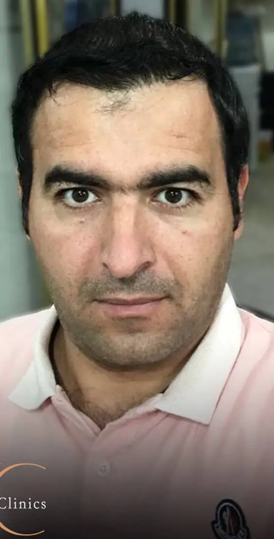 השתלות שיער לגברים