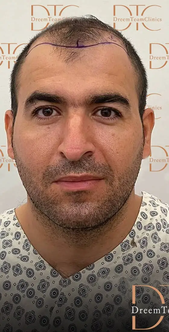 השתלות שיער לגברים