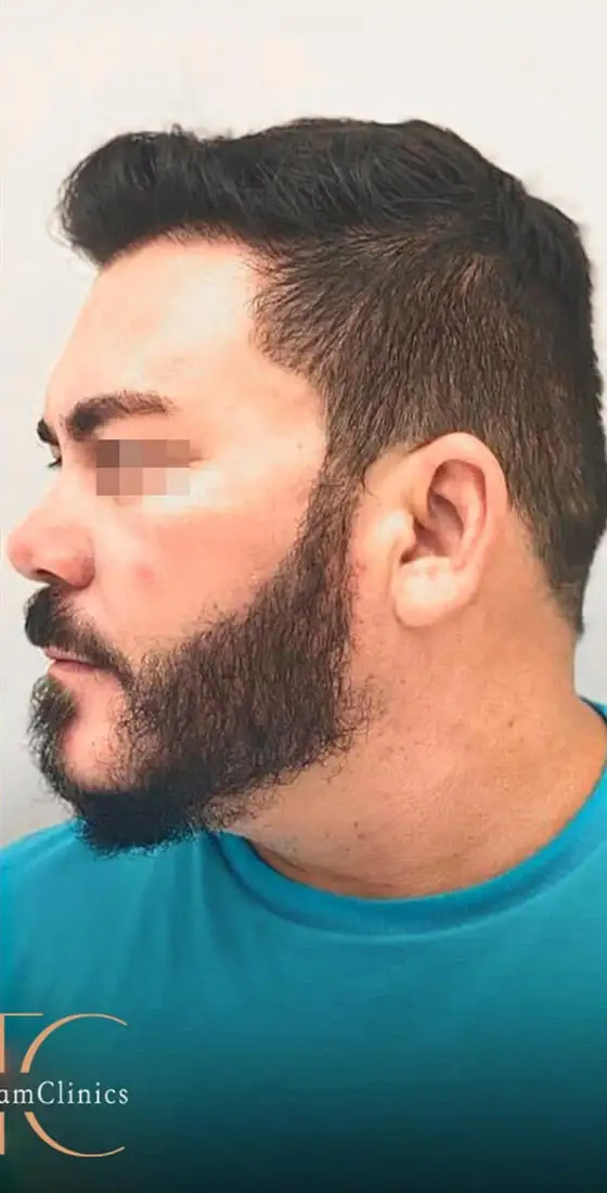 השתלות שיער לגברים