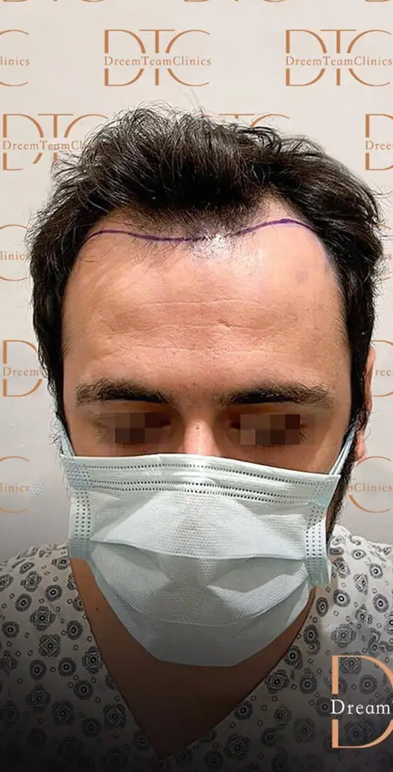 השתלות שיער לגברים