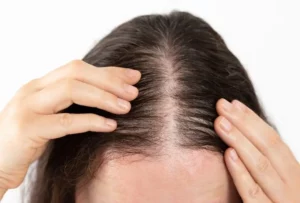 החלמה מהשתלת שיער