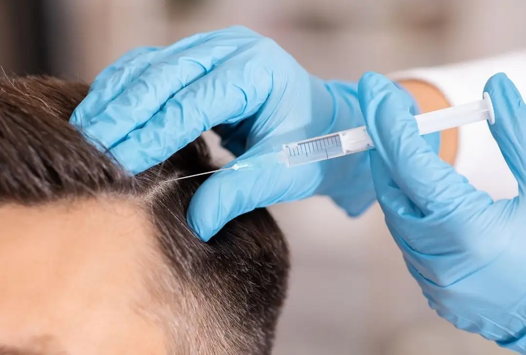 כמה זמן לוקח לשיער לצמוח אחרי השתלת שיער