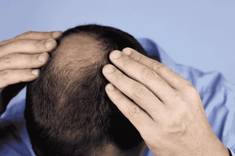 איך מתכוננים להשתלת שיער