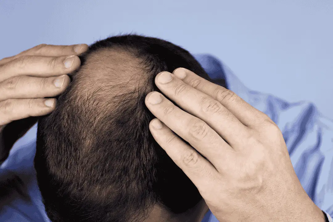 איך מתכוננים להשתלת שיער