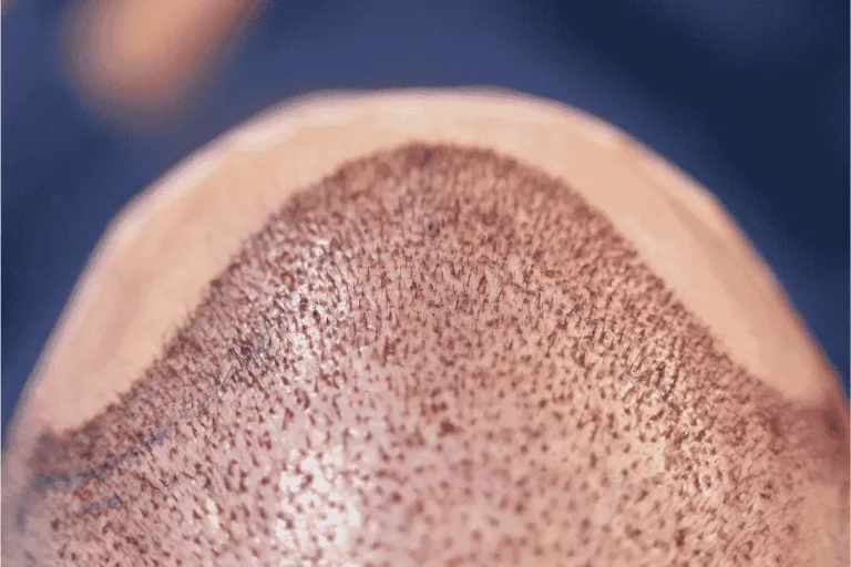 תופעות לוואי וסיבוכים אחרי השתלת שיער