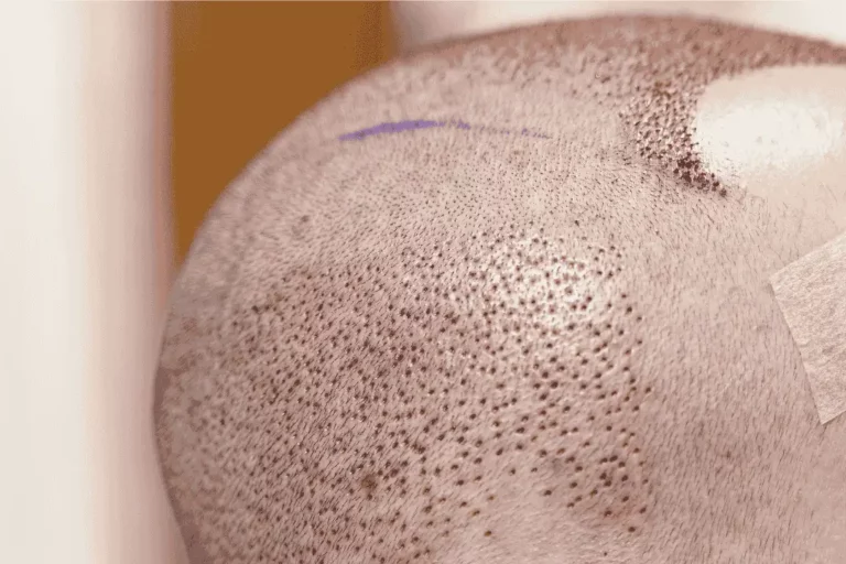 הכנה להשתלת שיער