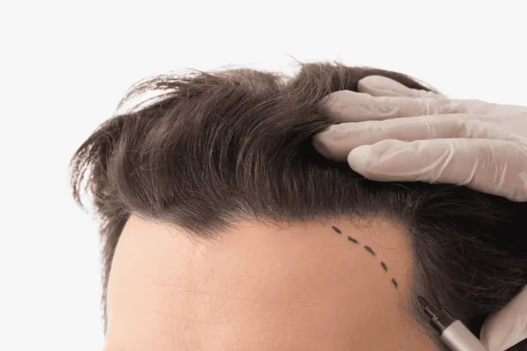 מאיפה לוקחים שיער להשתלת שיער