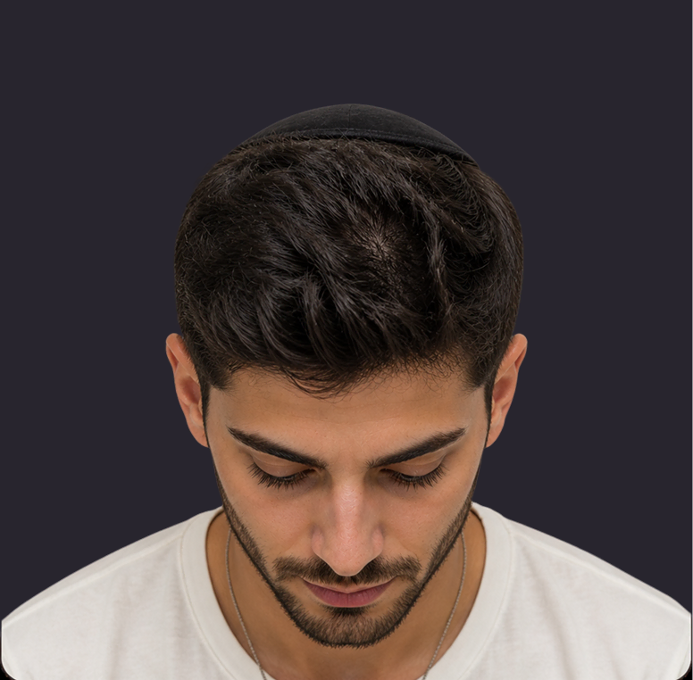 השתלת שיער לגברים תמונות לפני ואחרי