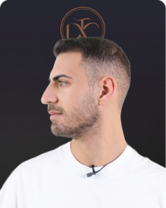 לפני ואחרי השתלת שיער בישראל