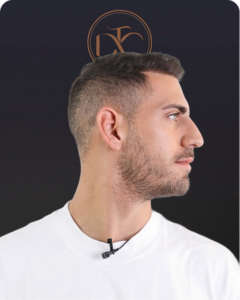 לפני ואחרי השתלת שיער לגבר